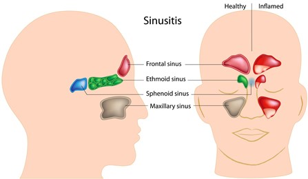 Sinus Infection Treatment Poway San Diego Sinusitis Rancho ENT