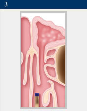 Illustration of the results of balloon sinuplasty in San Diego