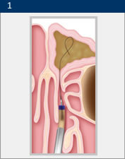 Illustration of the first step of surgical treatment for sinusitis