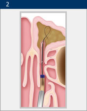 Illustration of balloon sinuplasty from Rancho ENT in San Diego