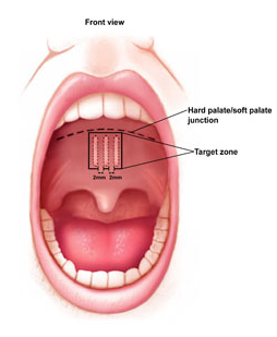 Illustration of surgical snoring treatment in San Diego