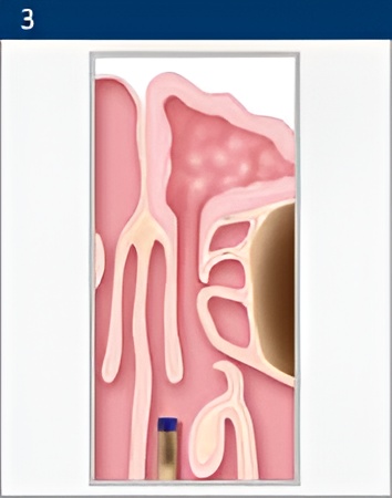 balloon-sinuplasty 3